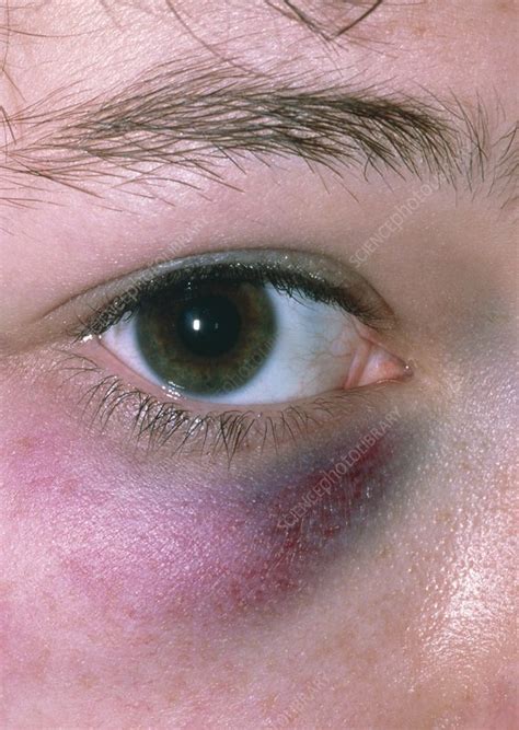 A black <strong>eye bruising</strong> will in most cases start off as red then gradually become darker as the <strong>bruising</strong> continues to swell. . Bruising around eyes without injury
